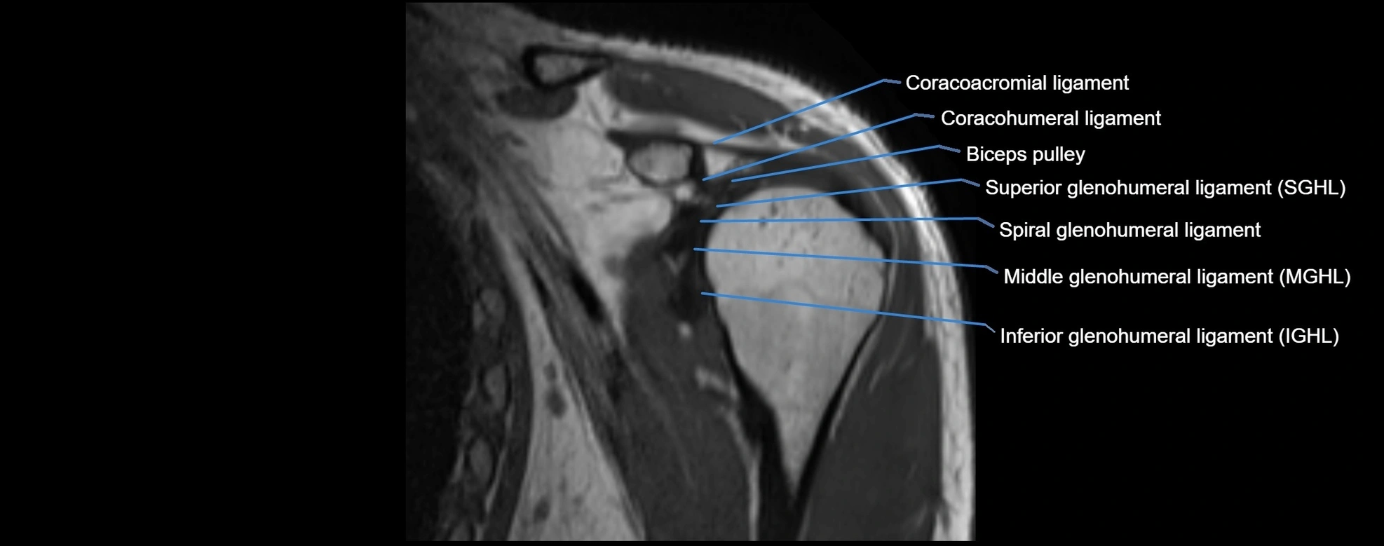 shoulder ligments coronal  cross sectional anatomy 3T MRI AI enhanced radiology image -img-00001-00013.webp